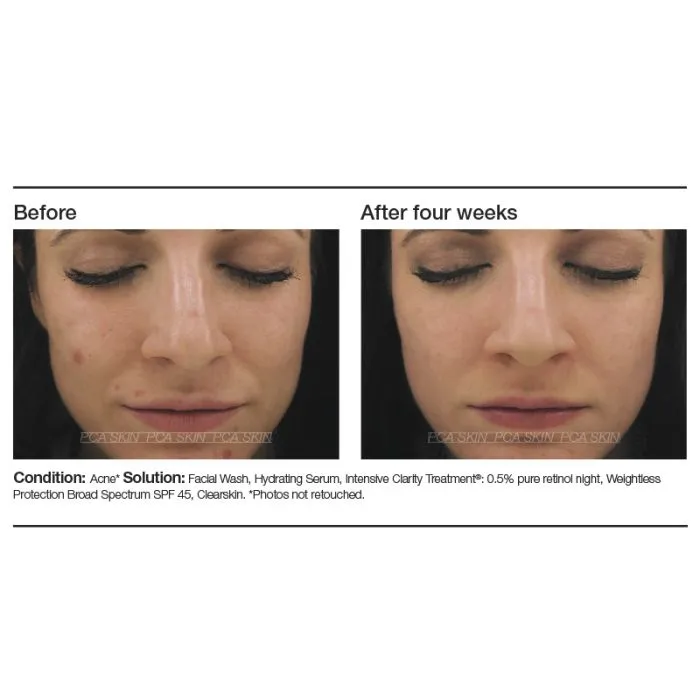 PCA Skin Intensive Clarity Treatment®