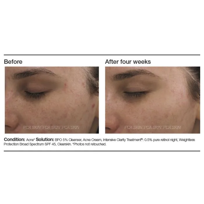 PCA Skin Intensive Clarity Treatment®